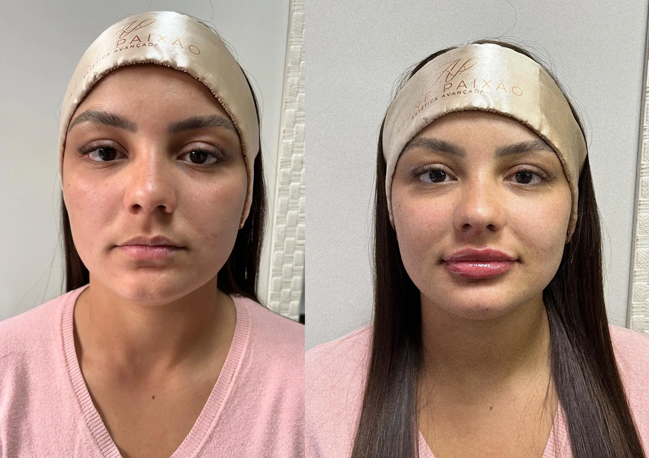 Resultado estético – antes e depois